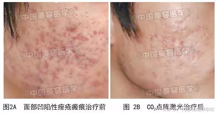 点阵激光治疗疤痕的原理,点阵激光治疗疤痕对比图