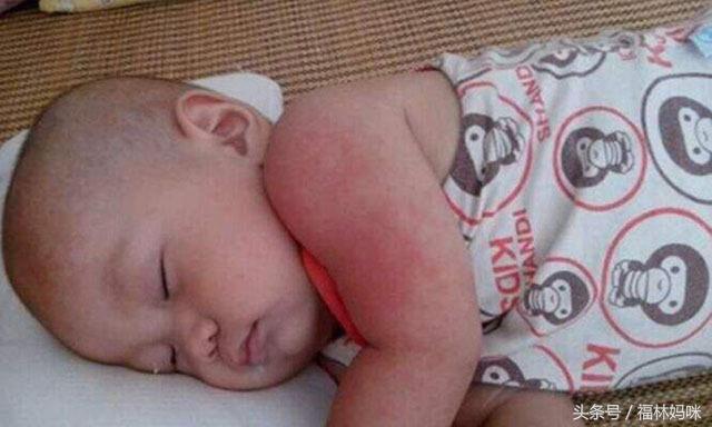 夏季如何避免宝宝长痱子,宝宝夏季出痱子怎么办