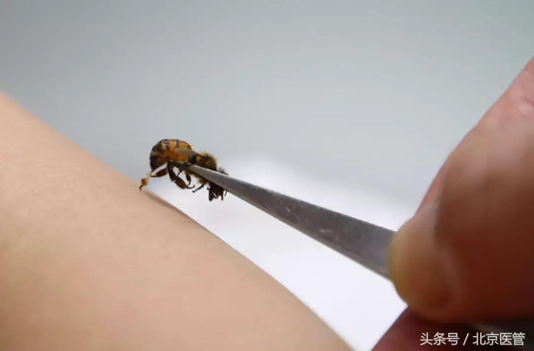 被蜂蜇伤怎么处理好得快,被蜂蜇伤的正确方法