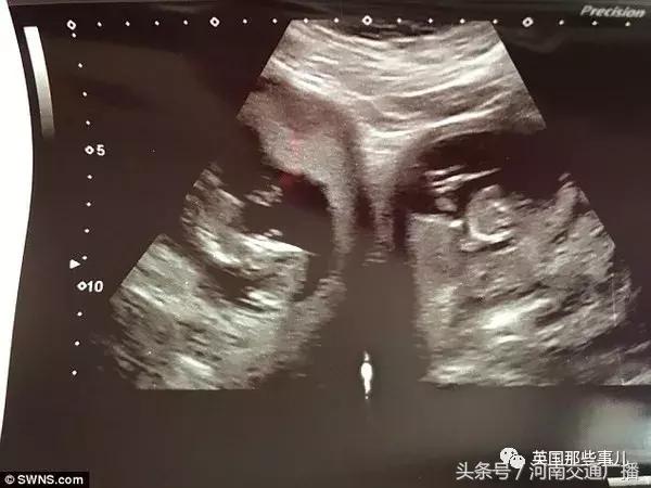 不完全双角子宫怀双胎,有人天生有两个子宫吗