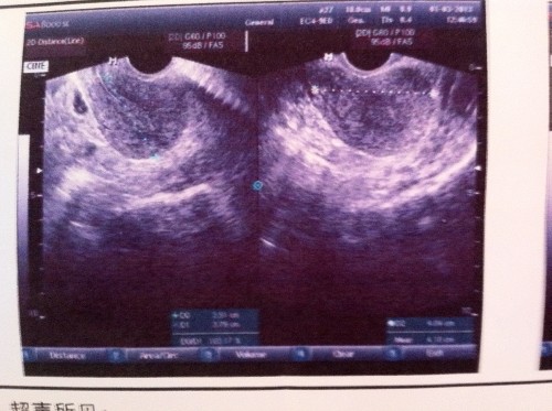 瘦人得多囊卵巢综合症有什么症状,多囊卵巢身体上会有什么症状么