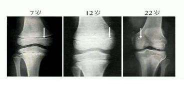 骨骺提前闭合真的不能长高吗,青春期孩子骨骺闭合如何长高