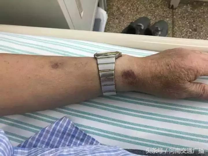 天呐！大爷吃掉上百支“皮炎平”软膏，医生一问都懵了