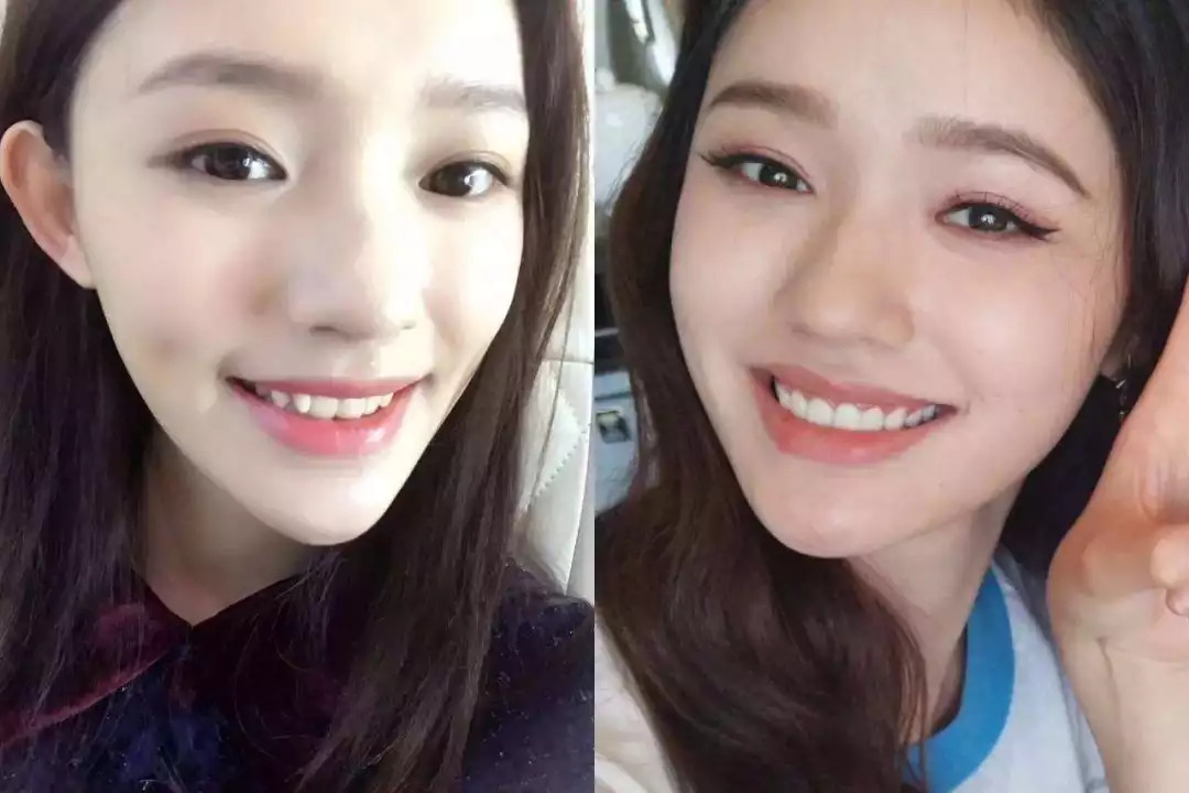 市面上冷光美牙仪真的有用吗,冷光美牙仪对牙齿伤害有多大