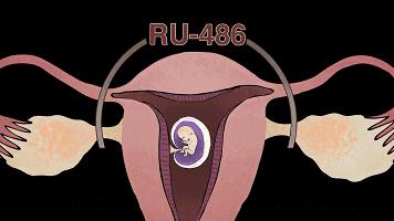 堕胎是杀人吗,堕胎就是杀生