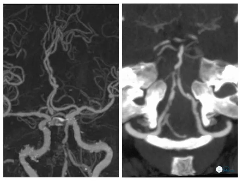 基底动脉重度狭窄介入治疗的风险,椎基底动脉重度狭窄的保守治疗