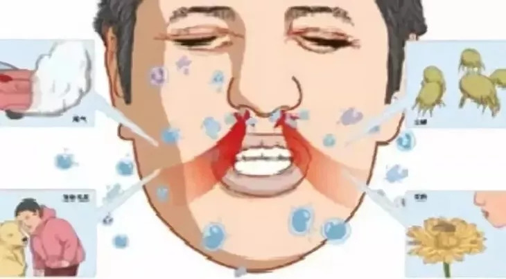 儿童鼻炎喷雾日本,日本儿童鼻炎神药