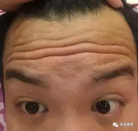 心血管疾病像长皱纹一样不可避免,脑门皱纹多与心血管关系