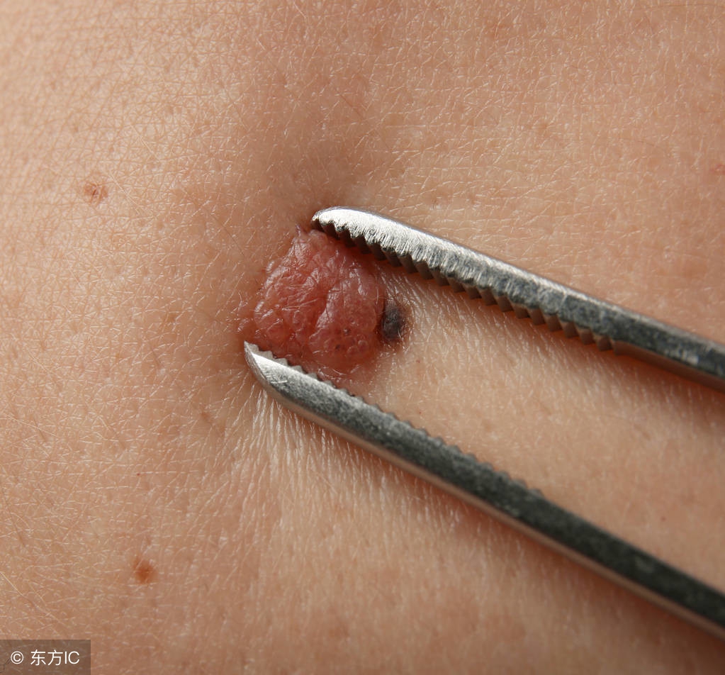 从小就有的痣可能会是黑色素瘤吗,先天性黑素细胞痣恶变的概率大吗