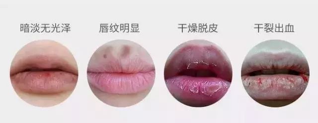 嘴唇干燥脱皮怎么快速去除,嘴唇一直干裂脱皮使嘴唇变丑