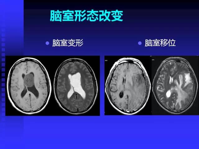 头颅mri读片视频教程,颅脑mri读片入门教程视频讲解全集