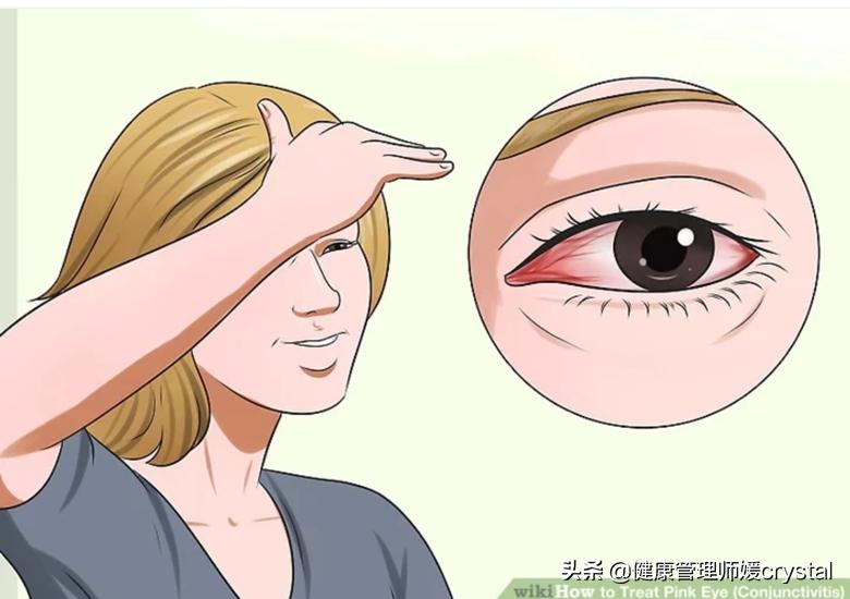 孩子突然眼睛红痒，医生：小心春季卡他性结膜炎，4个方法预防