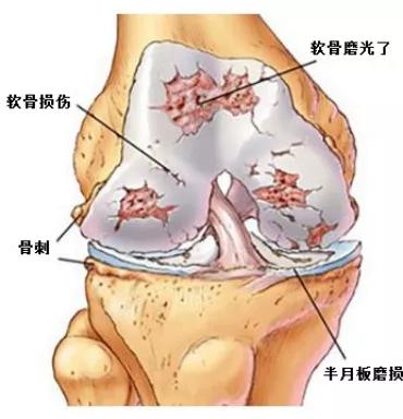 膝关节骨刺疼痛用艾灸有用吗,膝关节骨刺疼痛口服药