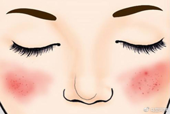 红血丝敏感肌肤怎么修复小妙招,自己去除高原红血丝最有效的方法