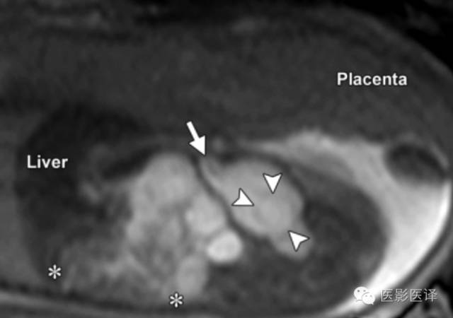 胎儿卵巢囊肿5.6厘米会消失吗,卵巢巨大囊肿与妊娠鉴别