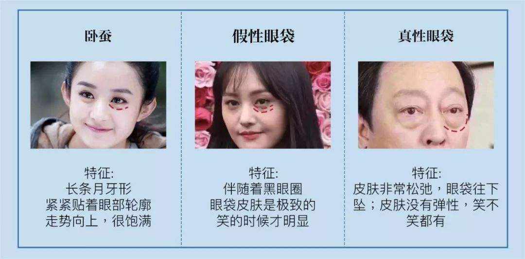 眼袋大显得老怎样才能永久祛眼袋,眼袋重怎么办祛眼袋其实并不难