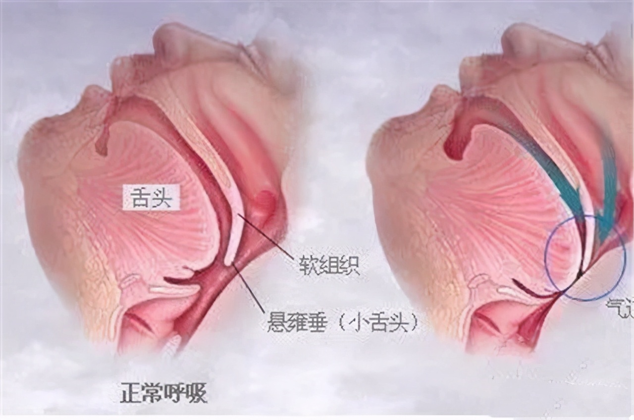 高血压脑出血急救视频,老年人突发脑出血应该怎么应急