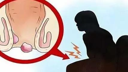 不做有「痔」青年——痔疮需要这样防治