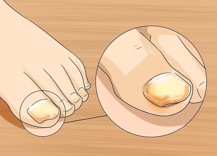 灰指甲是不是治疗不了,灰指甲是不是自己不好治