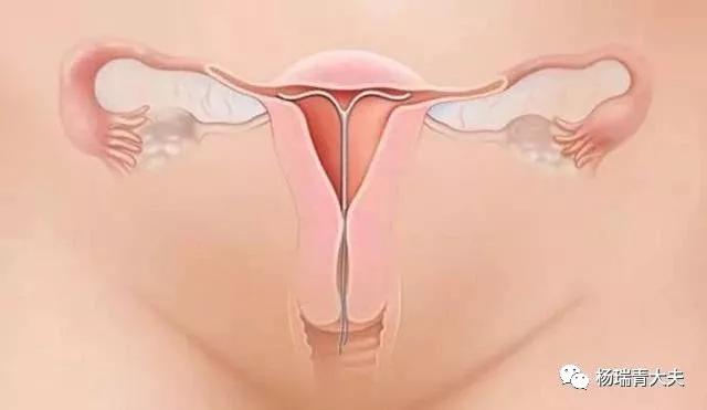 女人结扎哪里会有疤痕,女性结扎后多年结扎口有硬块