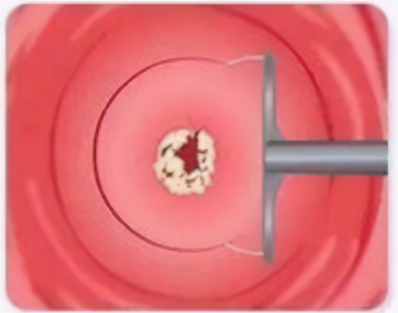 做了leep刀能正常怀孕生子吗,leep术后影响生孩子吗