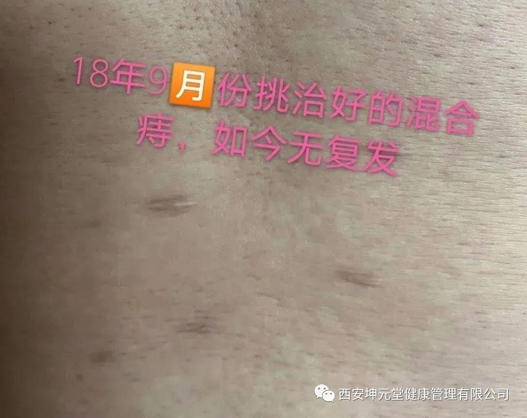 中医用截根的方法治痔疮可行吗,中医截根绝技