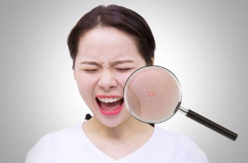 祛痘痘黑印用什么药,激光祛痘痘留下黑印子怎么办