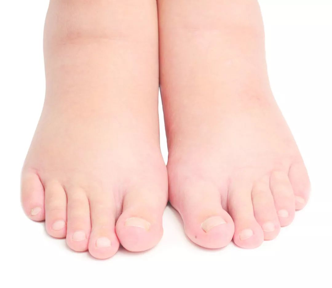 长期身体浮肿要警惕四种病,长期水肿吃什么药有效