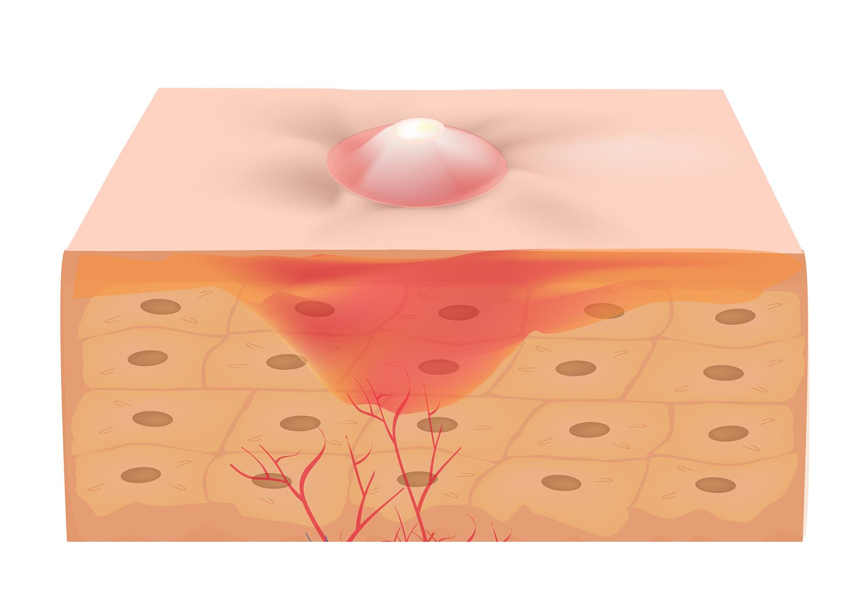 消灭痘痘闭口的方法有哪些,消灭闭口重现光滑肌soeasy
