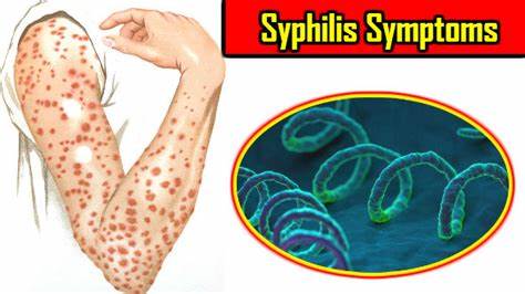 梅毒螺旋体检测阳性会传染吗,梅毒检查是阴性会传染给别人吗