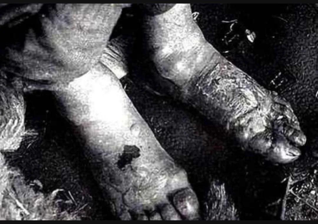 日军731冷冻实验,日军731部队冻伤实验是为了什么