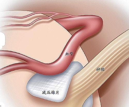 眼皮一直跳是哪里神经出问题了,眼皮总跳眼部神经抽动能放血么