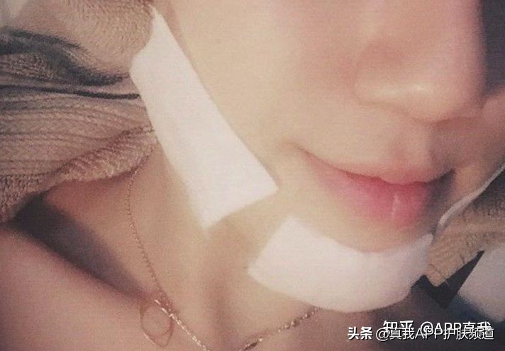 医院刷完水杨酸后注意事项,刷水杨酸棉片注意事项