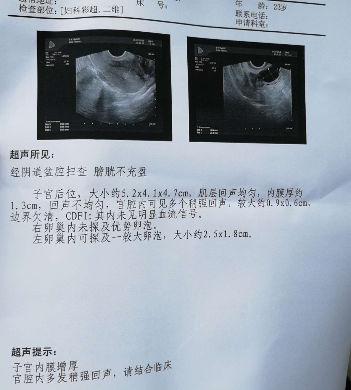 子宫息肉竟是妇科炎症引起的？会导致不孕吗？妇科专家教您咋预防