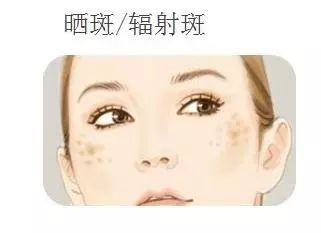 再美的脸，也抵挡不住“加斑”的困扰