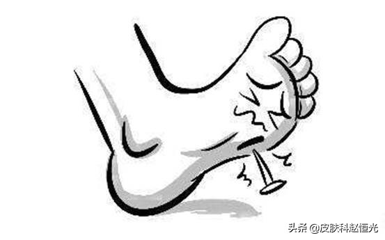 脚上长了个鸡眼它自己会好吗,脚上长的不是鸡眼但是特别疼