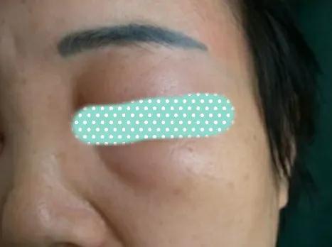 慢性荨麻疹吃什么药,慢性荨麻疹要吃中药调理吗