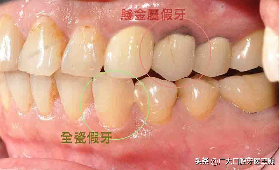 全瓷牙和烤瓷牙有什么区别哪个好,烤瓷牙和全瓷牙有什么区别怎么选