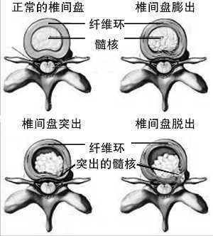 腰椎间盘膨出和滑脱手术会瘫痪吗,腰椎间盘膨出双下肢麻木会瘫痪吗