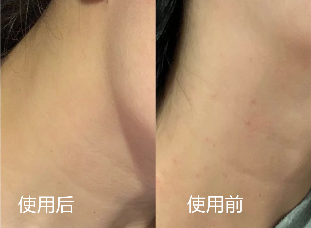 手动去脂肪粒工具,去脂肪粒神器排行榜