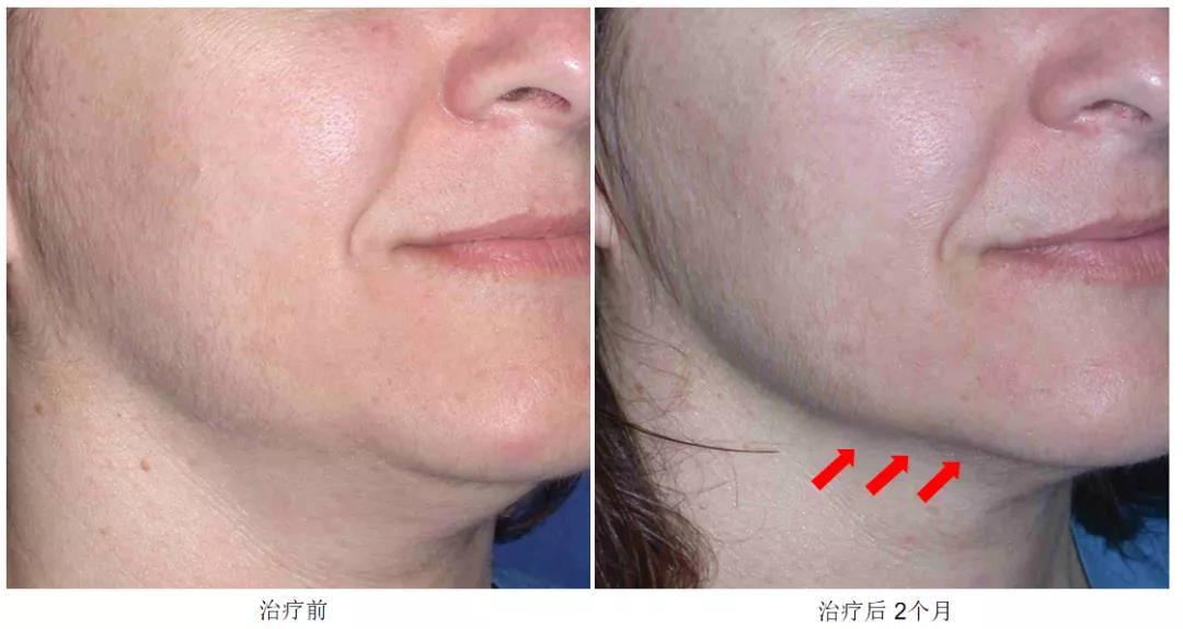 抗衰超声刀的原理和功效,超声刀超百万案例证实的抗衰效果