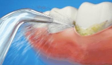 水牙线正确使用方法视频,水牙线冲牙器使用方法