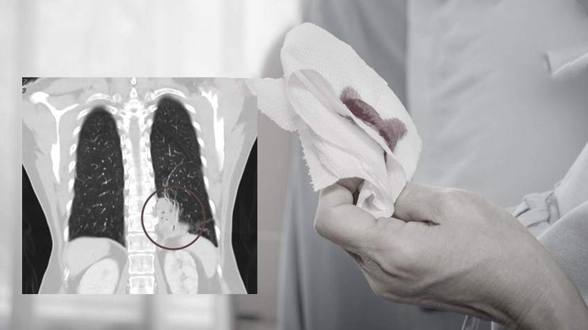 肺部癌变腿先知吗,肺部出问题喉咙先知