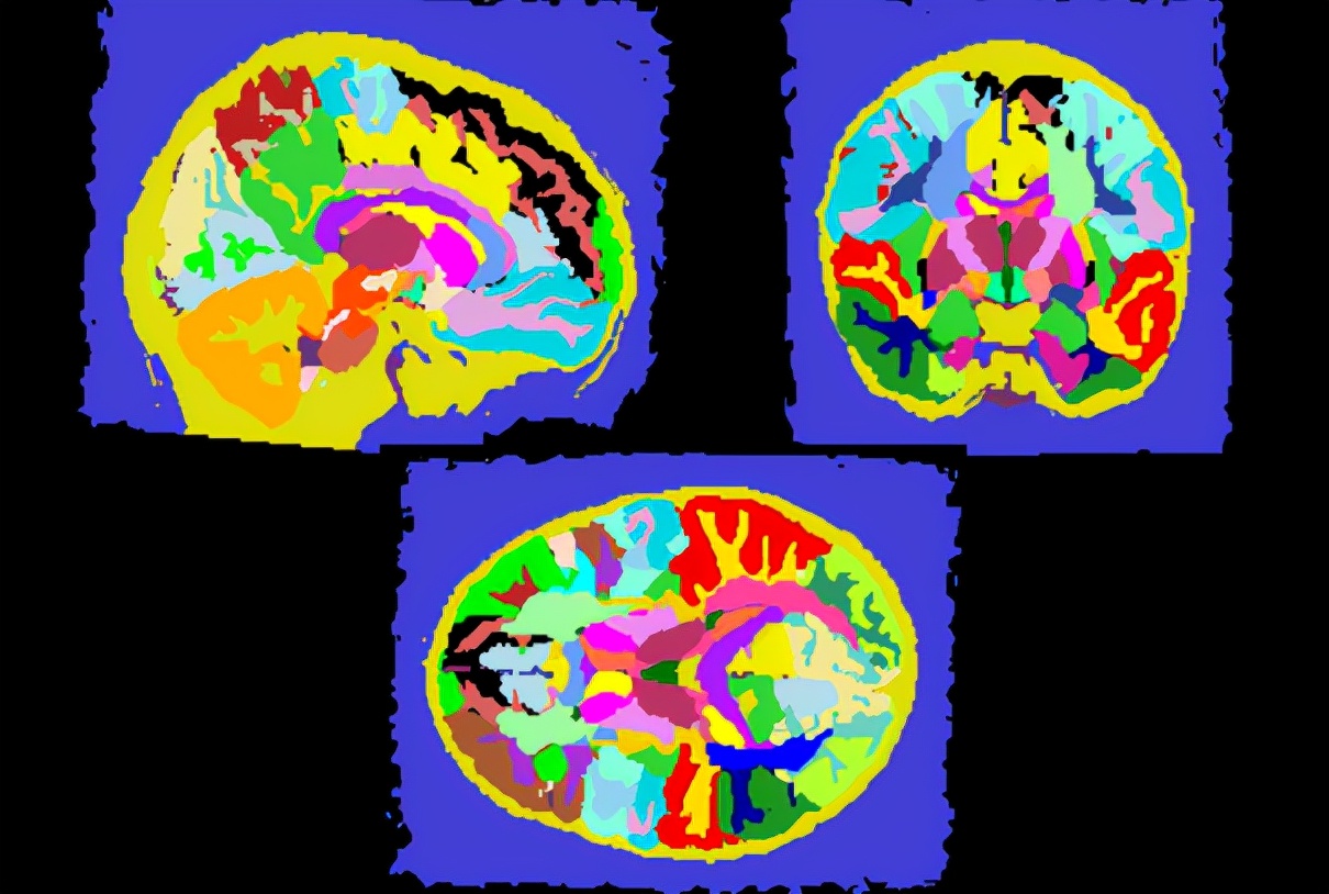 被自闭症掩藏的焦虑症：问题行为频发，却得不到诊治