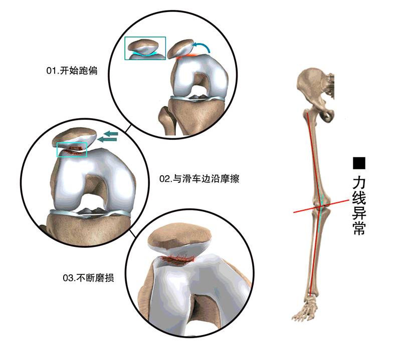 膝关节咔咔响隐隐作痛,下蹲时膝关节有小咔咔声