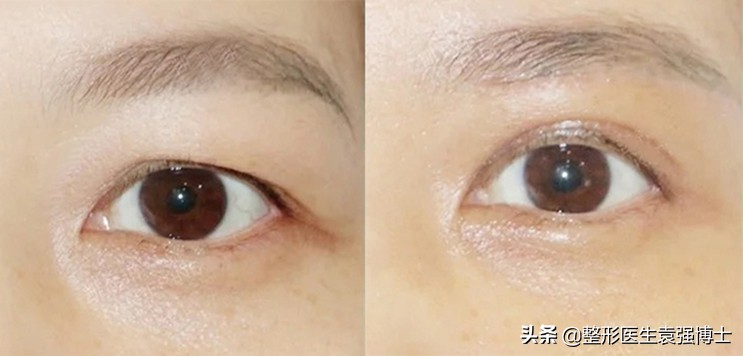 45岁眼皮耷拉下来怎么办,34岁上眼皮松弛需要提眉吗