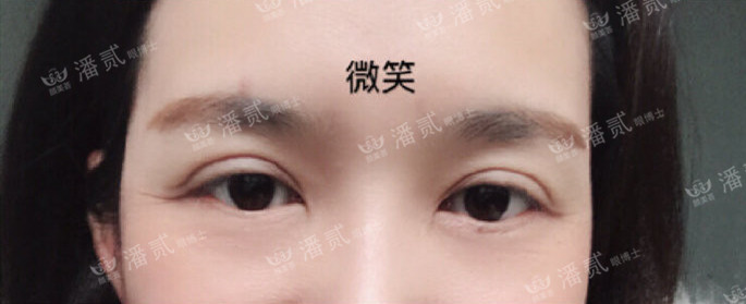 10个工作室做，9个毁，祛眼袋连卧蚕也没了，直接送我到10年后