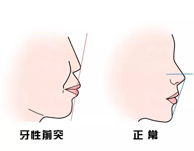严重的龅牙可以磨掉吗,严重龅牙可以矫正吗