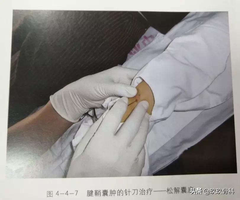 腱鞘囊肿针刺技巧视频,手指腱鞘囊肿正确挤压方法视频
