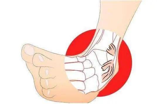 崴脚为什么会有后患,崴脚后治疗不彻底会有后患吗
